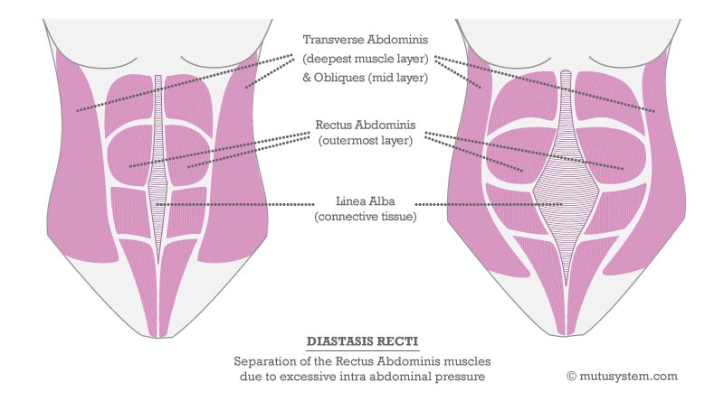 diastasis-recti-diagram