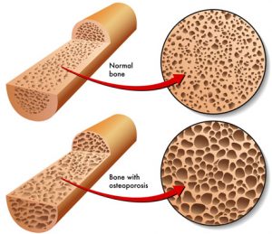 osteoporosis-diagram