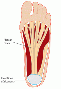 plantar-fasciitis